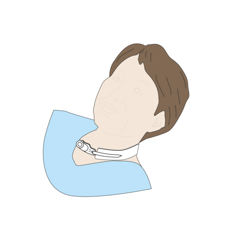 Tracheal cannula fixator