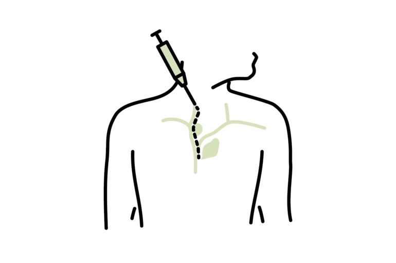 Central venous catheter – insertion and dressing